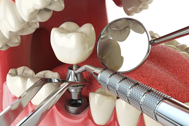 3D Mockup showing the components of a fully placed dental implant