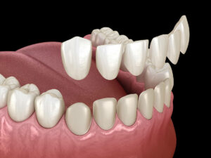 Mockup showing how dental veneers fit on teeth