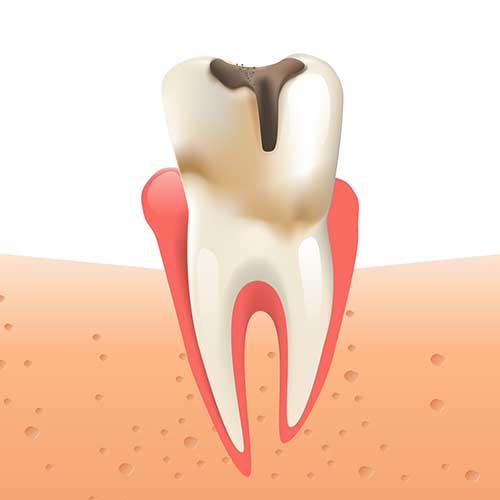 2D illustration of a decayed tooth